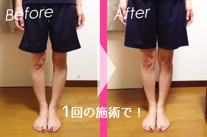1回の施術でこんなに変わる